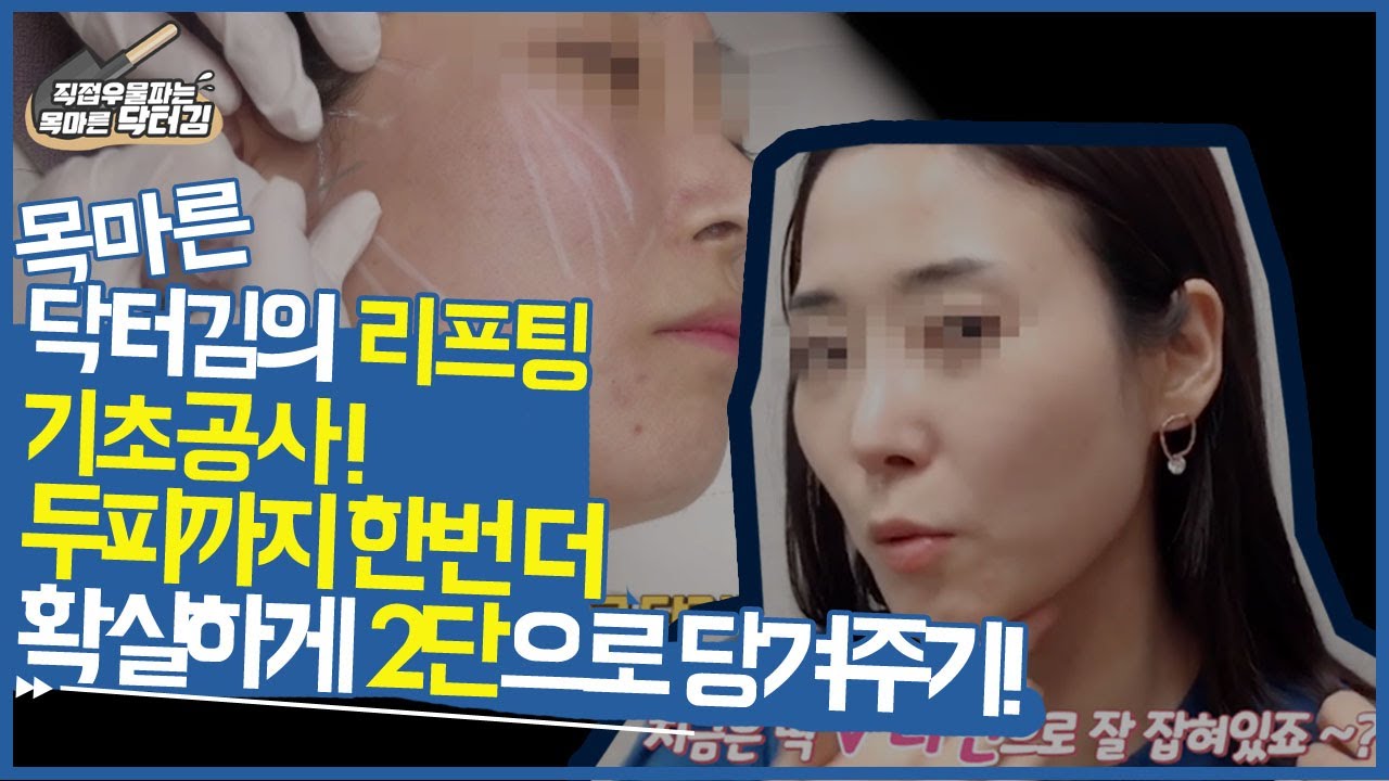 실리프팅 기초공사!두피까지 한번 더 확실하게 2단으로 당겨주기! 인생V라인실리프팅(부작용.붓기.시술당일효과)