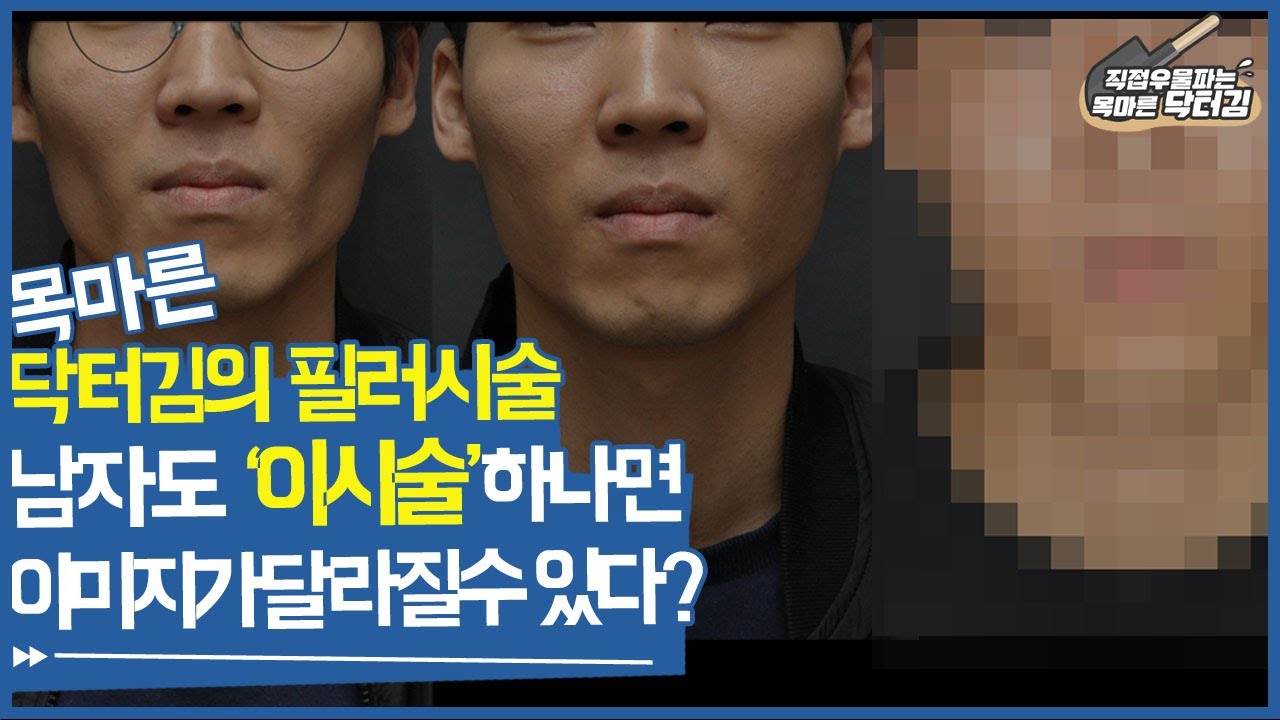 해골같이 푹 꺼진볼 자연스럽게 볼필러로 이미지 개선될까?#꺼진볼필러 #볼필러시술영상 #남자볼필러