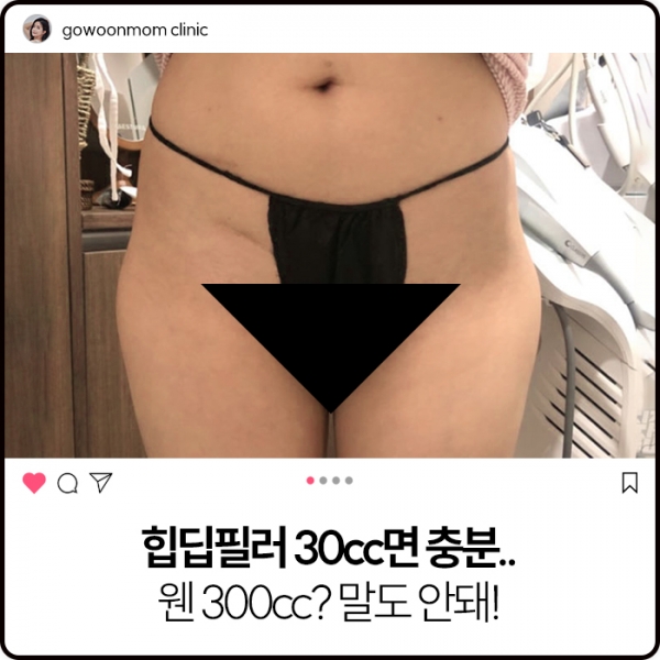 힙딥필러 30cc면 충분..  웬 300cc? 말도 안돼! 