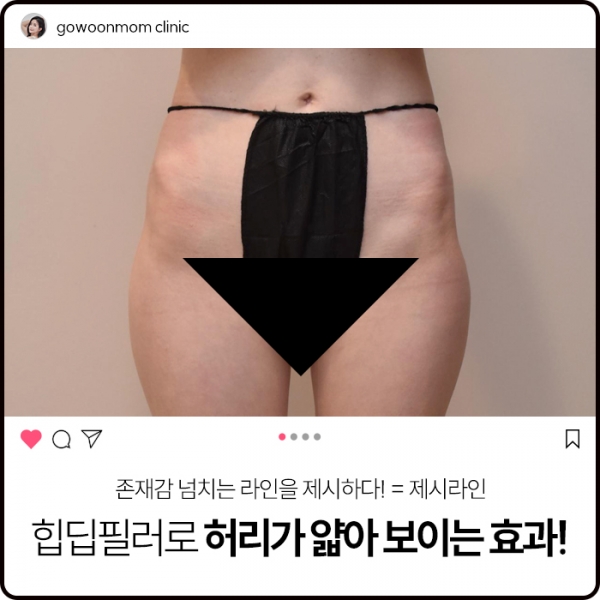 제시라인! 힙딥필러로 허리가 얇아보이는 효과!