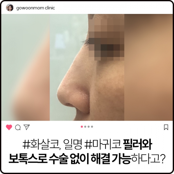 화살코! 수술 말고 화살코필러와 보톡스만으로 해결 가능"마귀코, 웃으면 안예뻐요 "