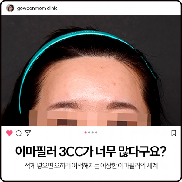 이마필러 3cc가 너무 많다구요?