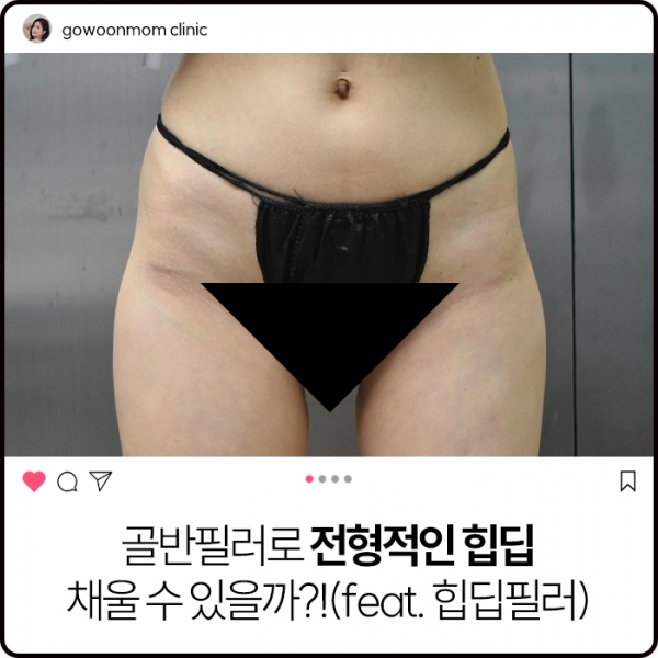 골반필러로 전형적인 힙딥 채울 수 있을까?(feat.힙딥필러)