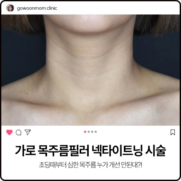 가로 목주름필러 넥타이트닝 시술 : 초딩때부터 심한 목주름 누가 개선안된대?!