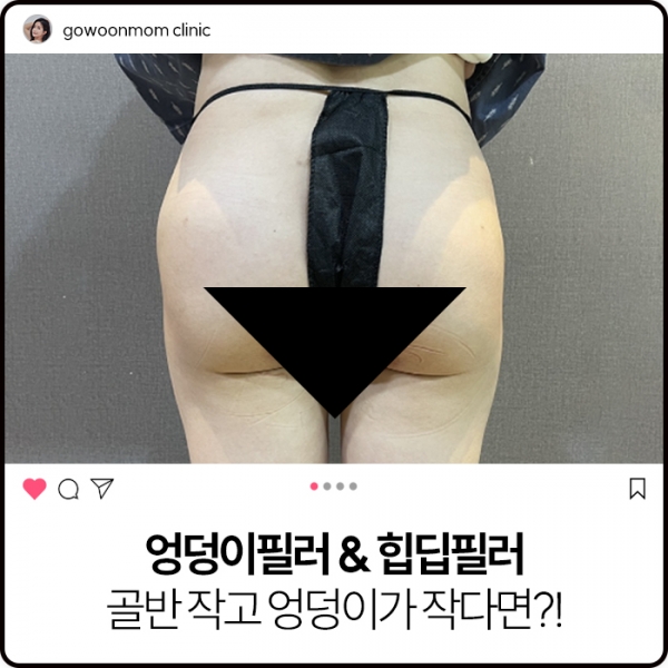 엉덩이필러&힙딥필러 : 골반 작고 엉덩이가 작다면?!