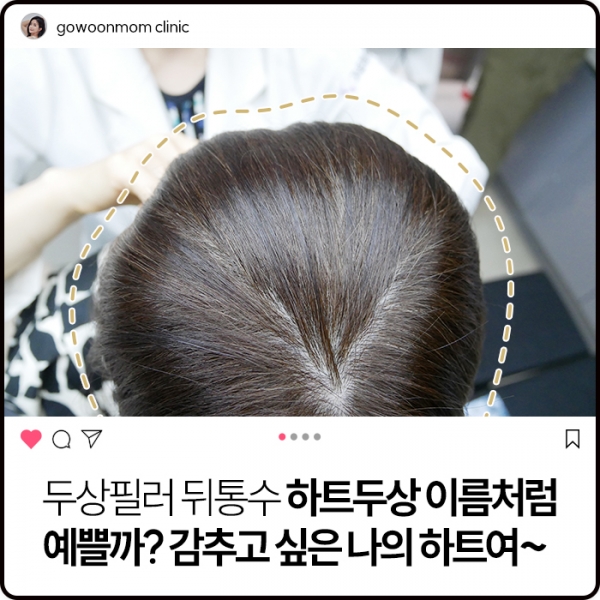 두상필러 뒤통수 하트두상 이름처럼 예쁠까?감추고 싶은 나의 하트여~~