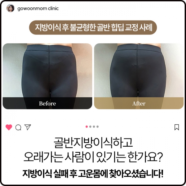 골반필러 힙딥 :골반지방이식 부작용 /오래가는 사람이 있기는 한가요?